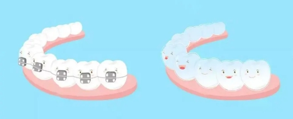 AO自锁和国产自锁托槽在价格与性价比上的区别