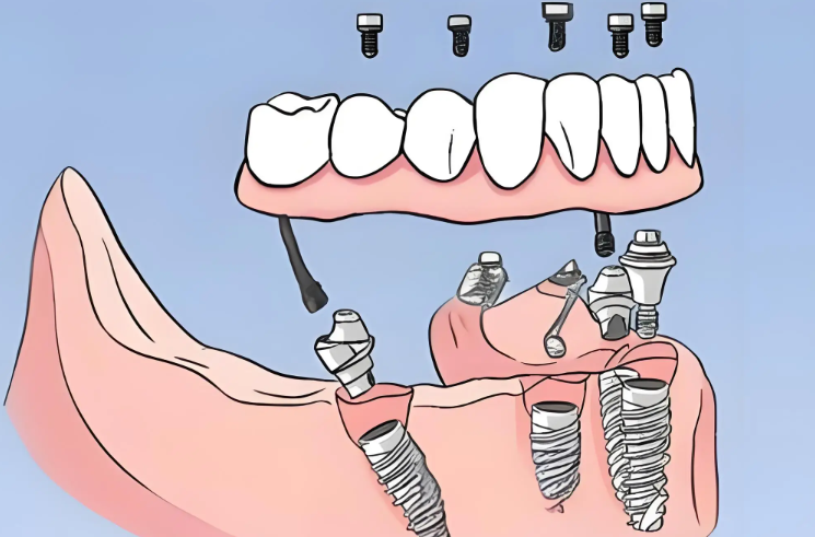 三、济南镶牙价格及选择建议