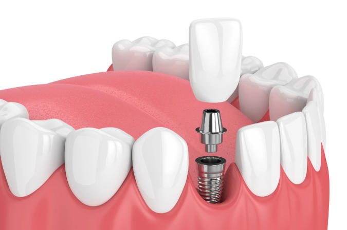 8020种植牙连锁机构信息及地址电话
