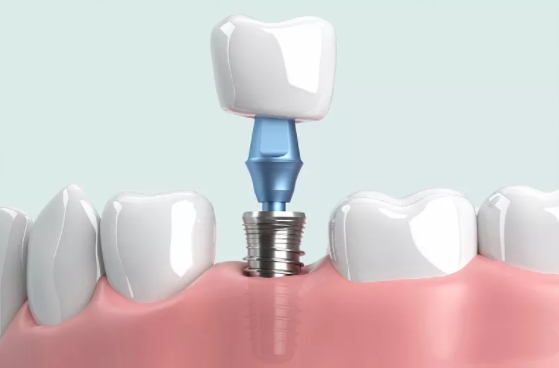 大清西格种植牙材料是进口的吗www.59w.net