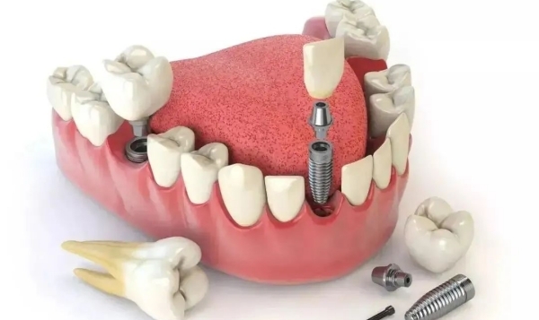 如何判断大清西格种植牙材料是否适合自己