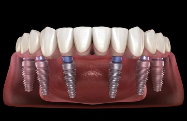 包头一机口腔种植牙价格优势