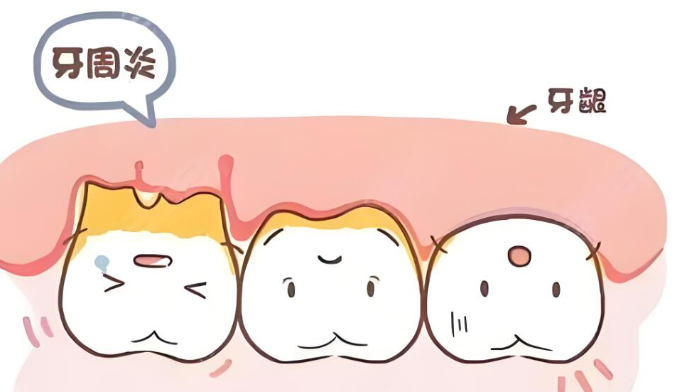 包头一机口腔医院牙周病治疗