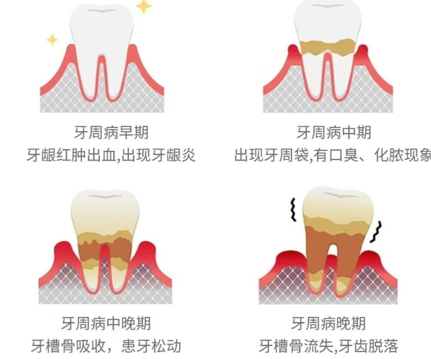 包头一机口腔医院牙周病治疗价格