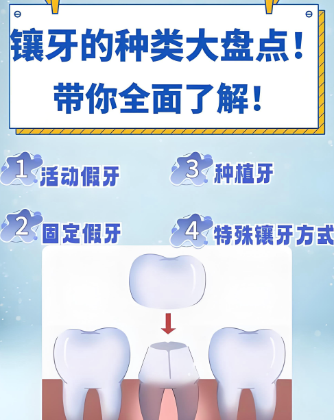 五、纯钛钢托属于什么档次？使用时需注意这些