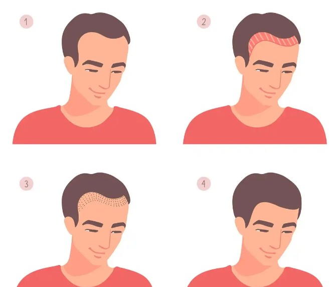 从脱发困扰到重获秀发