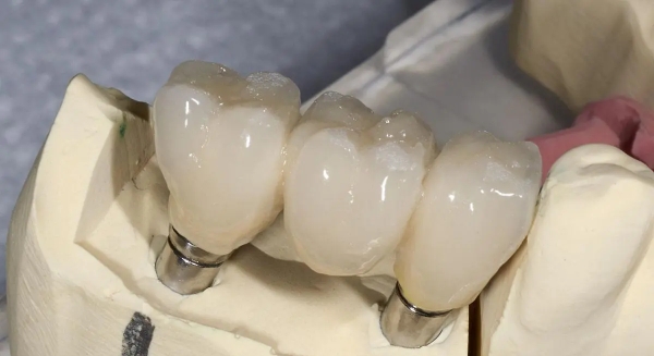 全瓷牙套这两年价格下降带来的好处