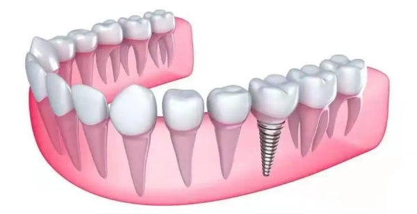 北京美铭口腔平谷畅观楼店种植牙价格