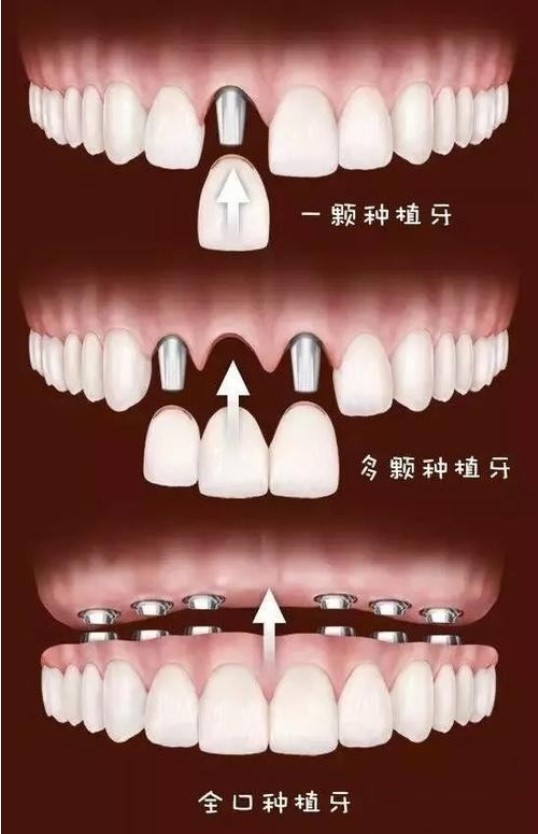 常德种植牙价格对比与技术选择指南