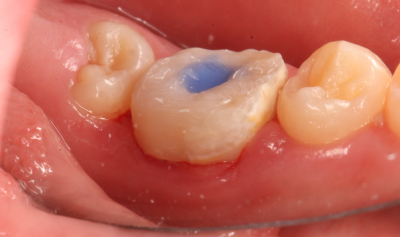 儿童补牙常见问题解答