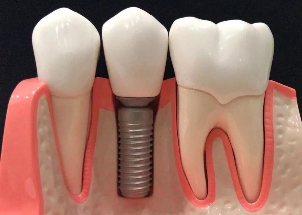 大清西格种植牙淘汰了吗？性价比高、生物相容好，2026年仍值得考虑