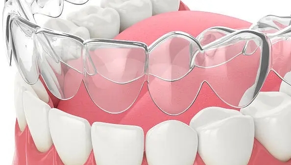 正畸矫正器价格