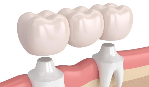 选择义佳微纳熔覆义齿和全瓷牙时要注意什么