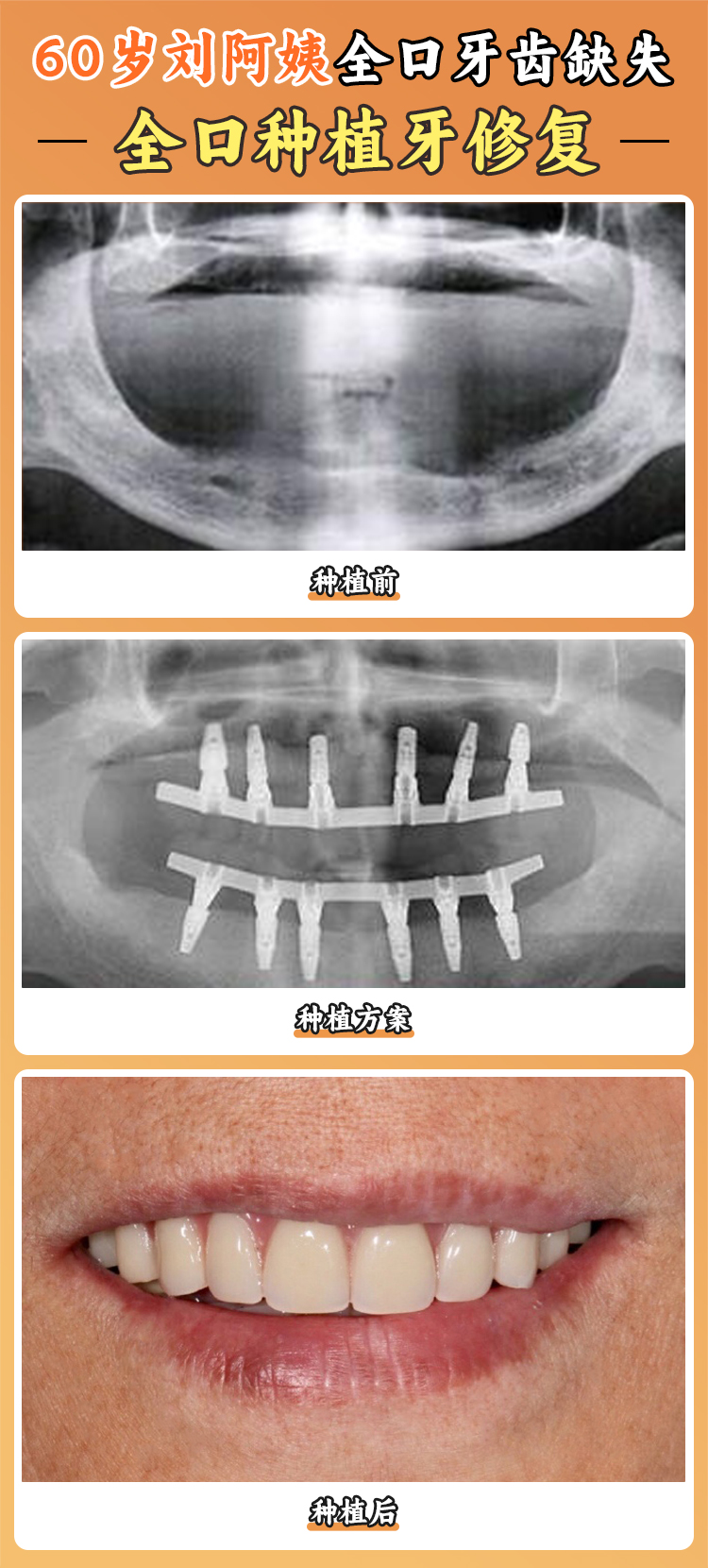 种牙 10 年真香现场！啃排骨、嚼坚果自由，现在笑起来比同龄人年轻 5 岁
