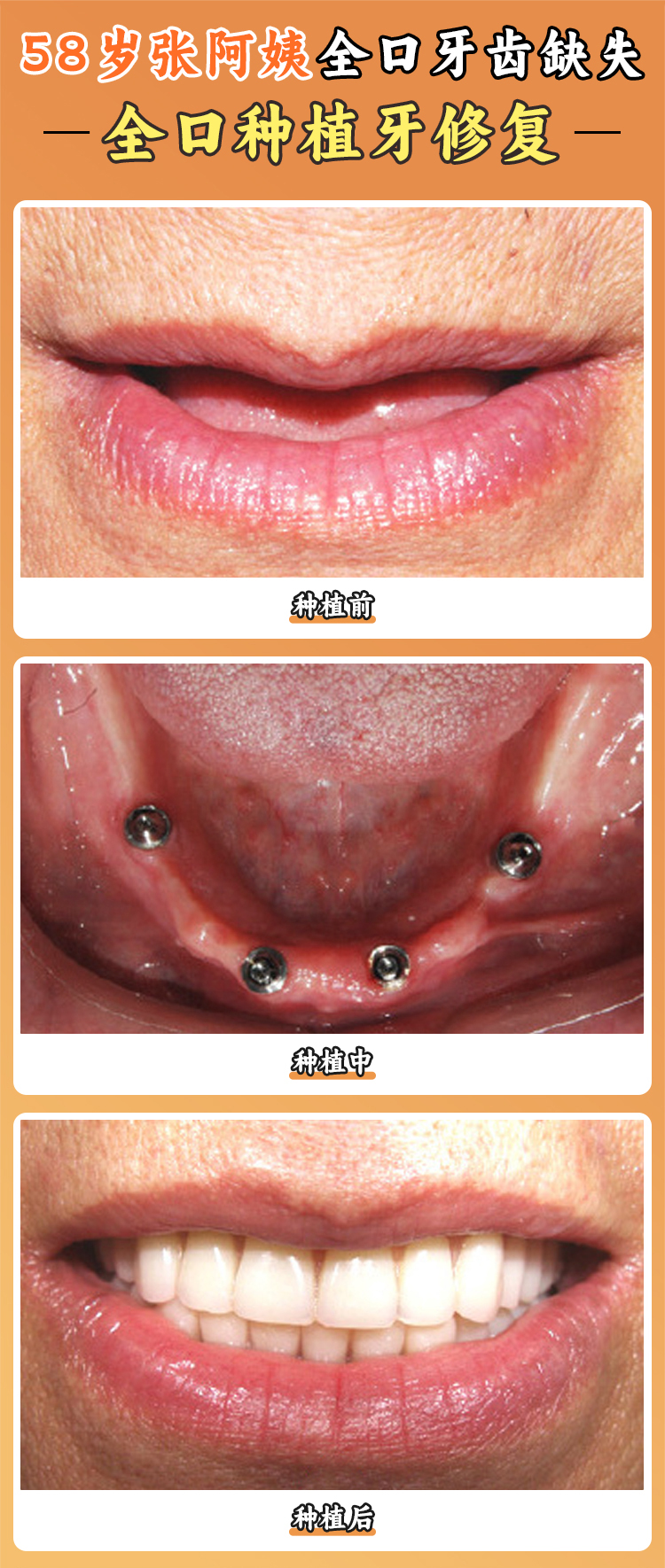 纠结 3 个月选对医生！全口种植手术全程实录：打麻药疼不疼？变好期遭罪吗？