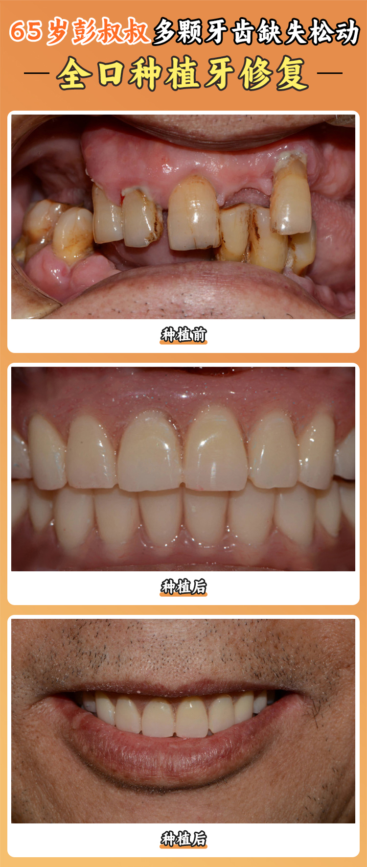 种牙前：55 岁没牙的日子太煎熬！嚼不动饭、不敢笑，连孙子都嫌我 “邋遢”