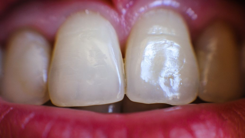 诺贝尔口腔医院2025年洗牙补牙收费参考