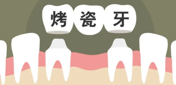 如何选择适合自己的义佳烤瓷牙