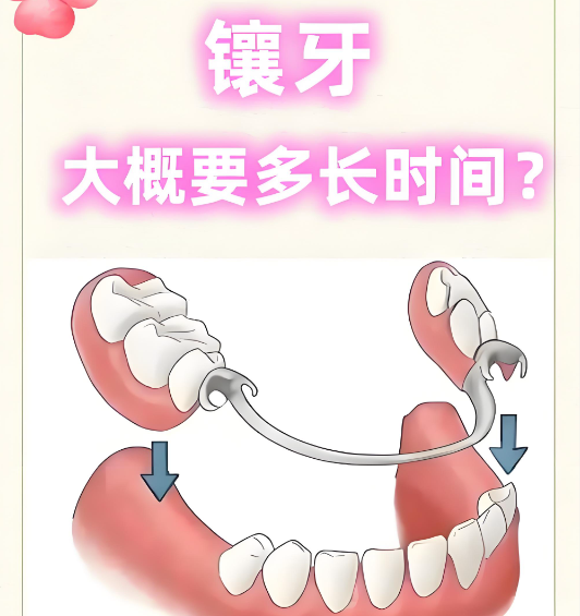 四、德国无挂钩镶牙有哪些适用人群和注意事项？