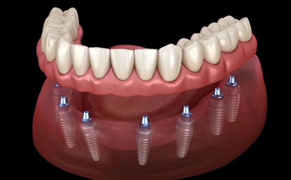 那些种植牙靠谱么