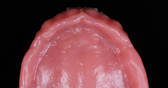 无挂钩镶牙做全口修复的技术原理是什么