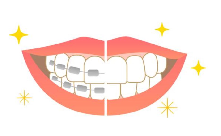 舒雅齐40副牙套