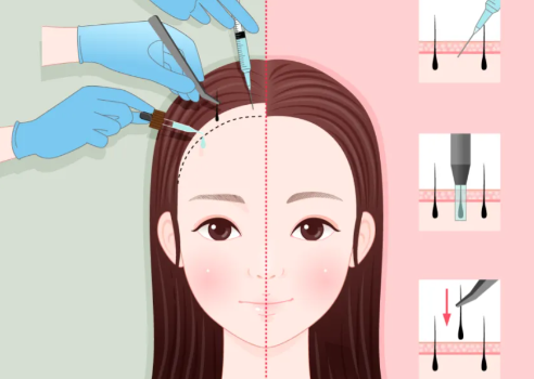 重庆华肤植发的AHT加密技术16元起