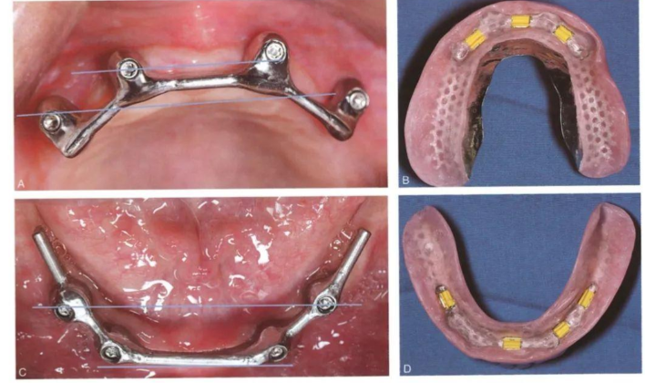 locator与杆卡区别全对比