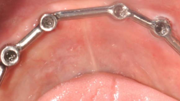 Locator是在单颗种植体上安装“按扣”装置