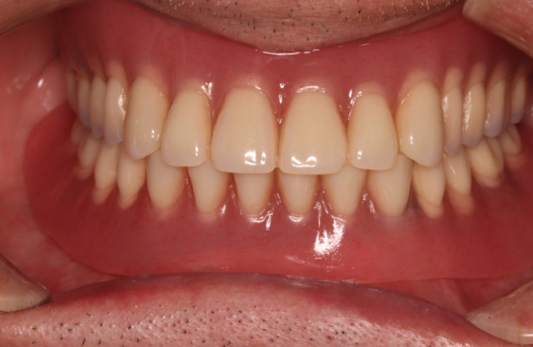 locator覆盖式义齿是什么材料