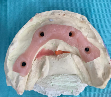 覆盖式义齿材料有哪些特性？