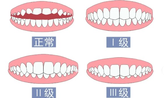 成人隐形矫正牙齿费用贵吗