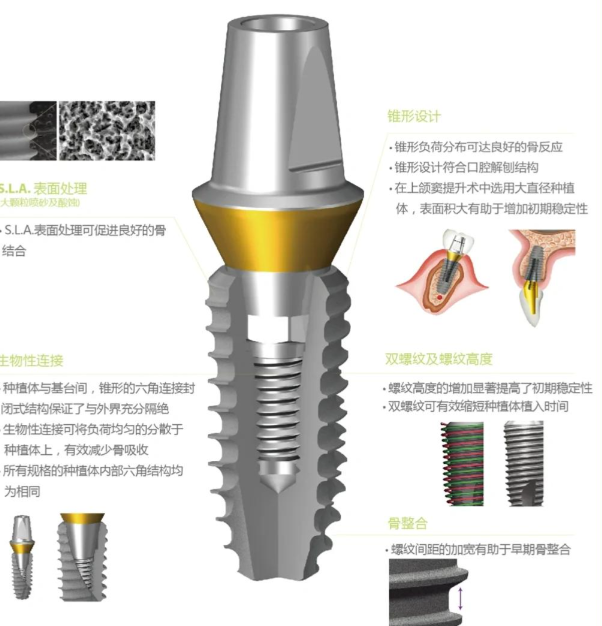 美国百康和诺贝尔牙体哪个好？种植牙性能PK：3大核心差异+真实案例解析