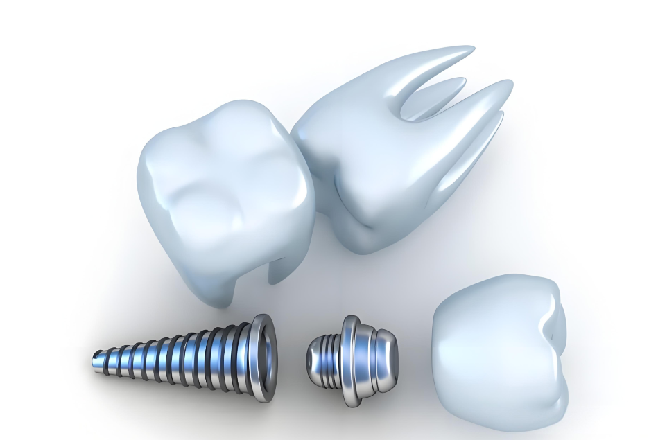 百固源种植体和大维种植体项目医院推荐