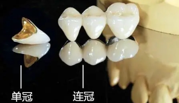 义佳微纳熔覆烤瓷牙可以做磁共振吗？医用合金基底，中老年人优先修复方案