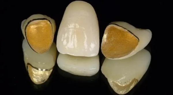 义佳微纳熔覆烤瓷牙怎么样