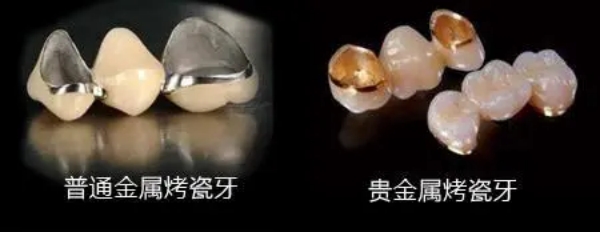 义佳微纳熔覆烤瓷牙适用于哪些人群