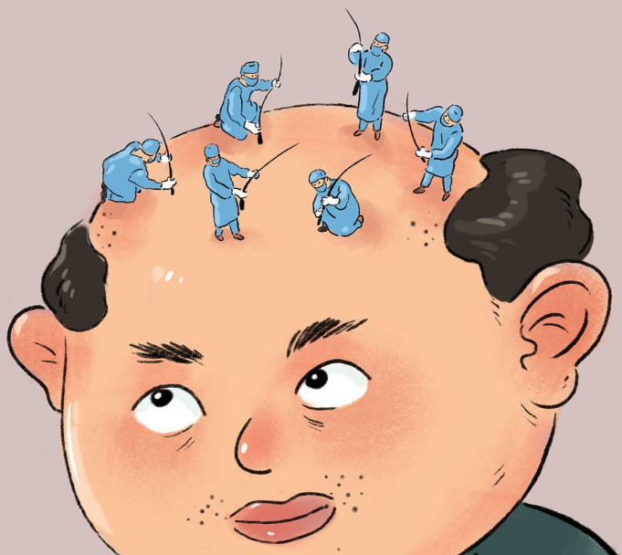 深圳倍生植发微针植发就诊攻略