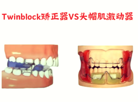 tb矫正器能把下巴导出来多少？真实案例：12岁女孩佩戴1年下巴前移3mm，疗效超预期