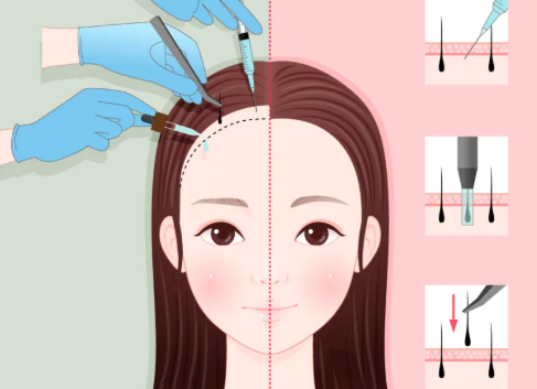 武汉仁爱植发医院和雍禾植发预约挂号对比