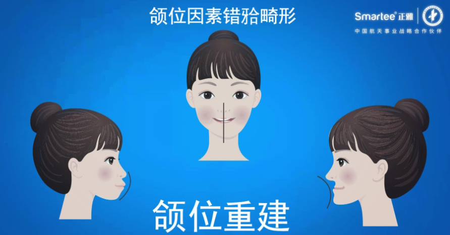 正雅GS颌位重建适合骨性嘴凸吗？3个月实测下巴前移5mm，3.5w元起不手术矫正