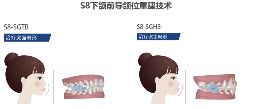 正雅GS颌位重建的临床疗效分析