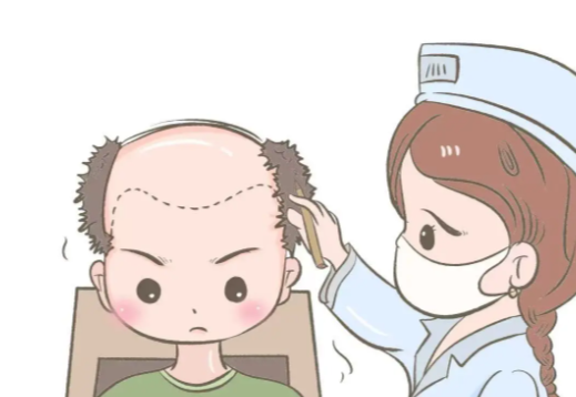 对于特殊脱发类型,李峥医生采用高密度种植技术