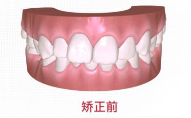 朱维冰正畸价格真实测评