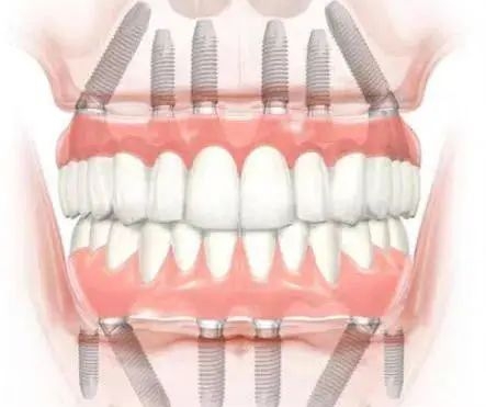 二、济宁种植牙价格差异原因