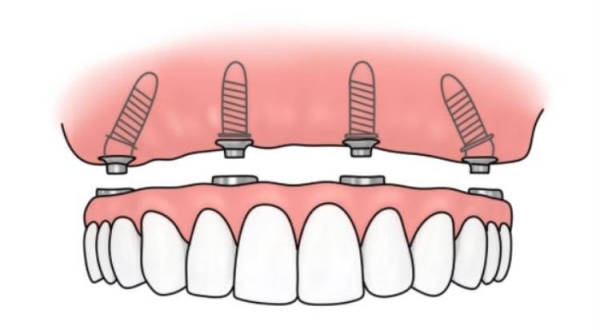 三、济宁种植牙价格表收费特点www.59w.net