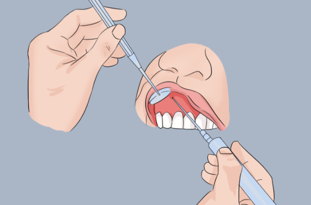 南平延平植雅口腔拔智齿术后护理指南