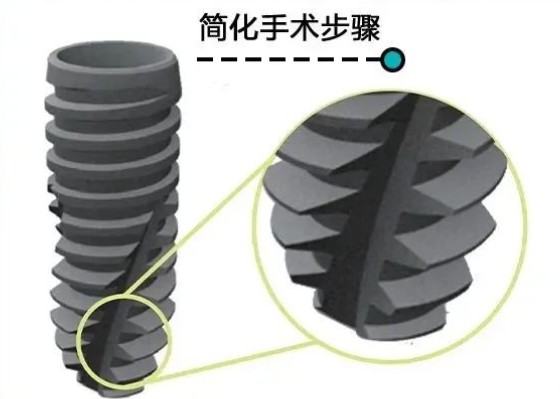 三、科威尔种植体的适用人群与选择建议