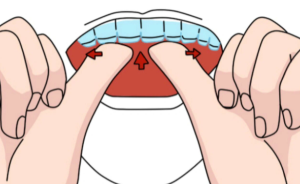 如何选择适合自己的隐形牙套