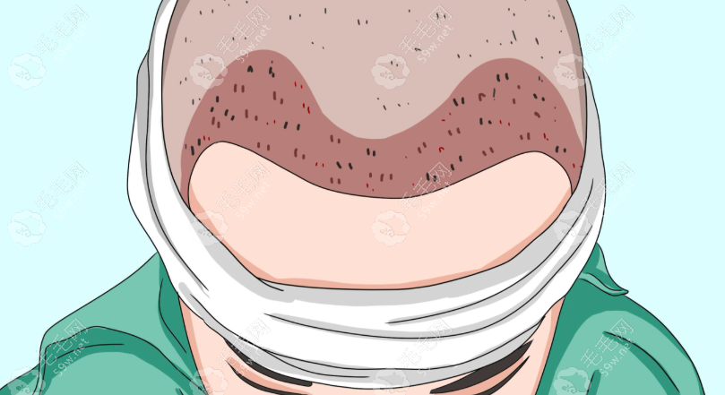 南宁雍禾植发价格一览表:含发际线/头顶/眉毛/私密种植收费